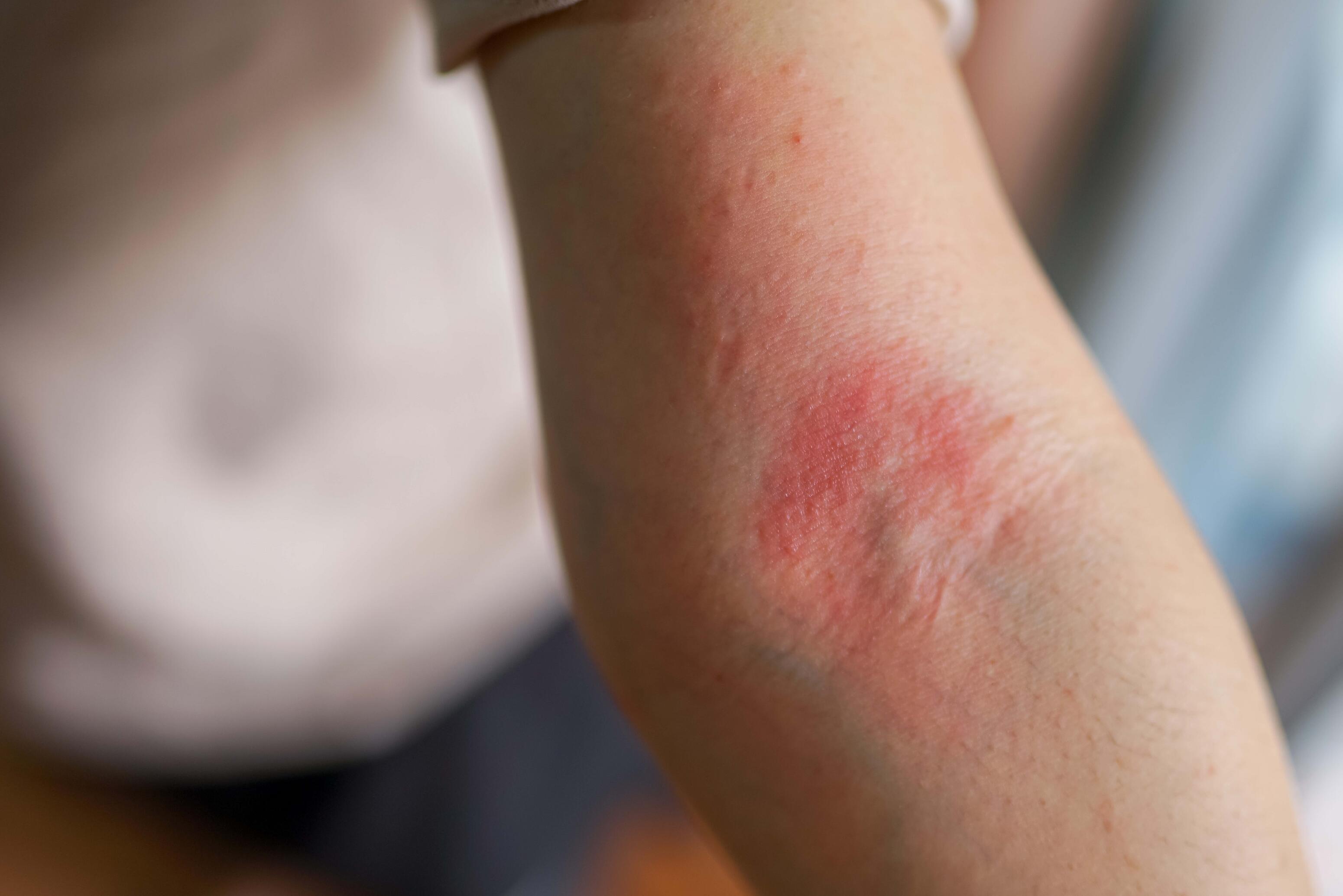 symptomes eczéma sec